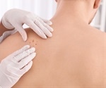 Sexual orientation affects skin cancer risk in the USA