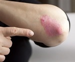 Cancer risk in psoriatic patients