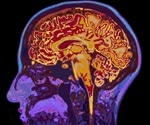 What is Dementia?