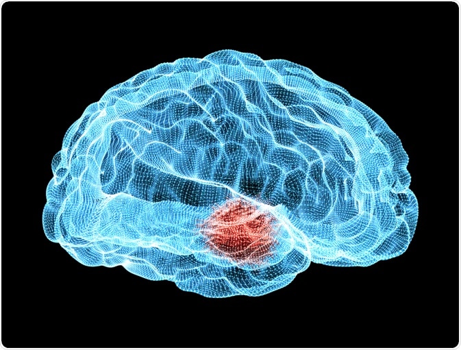 Parkinsons Disease Parkinsons Disease