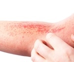 Daily moisturizer does not prevent eczema according to new research