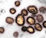 Coronavirus HCoV-NL63 associated with croup
