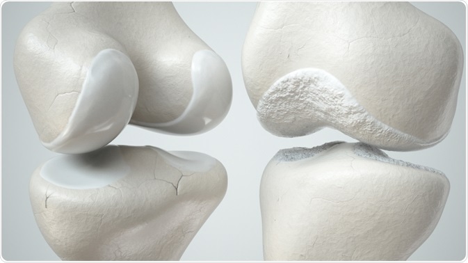 Osteoarthritis Osteoarthritis