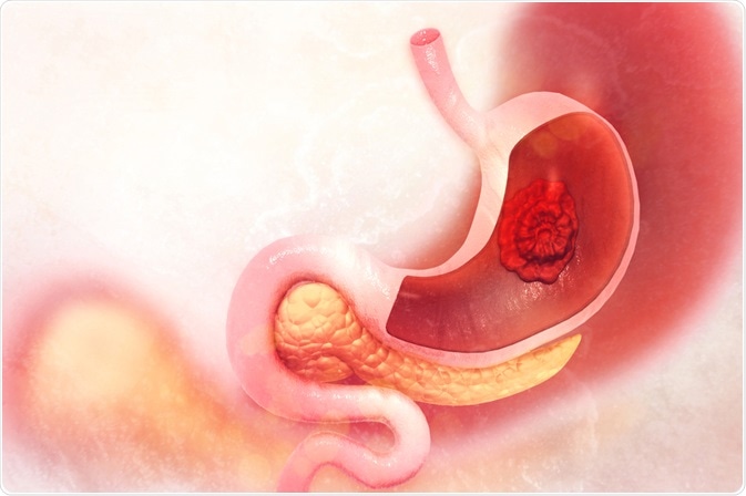 Gastric Cancer Gastric Cancer