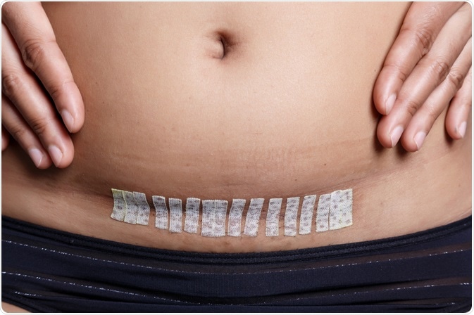 hysterectomy