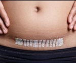 What is a Hysterectomy?