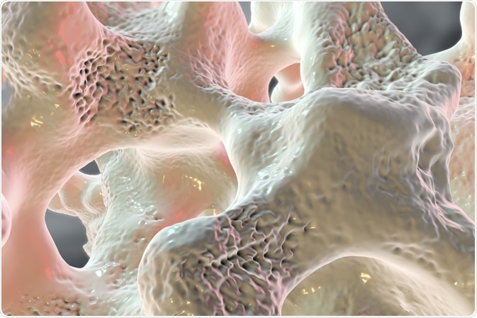 osteoporosis