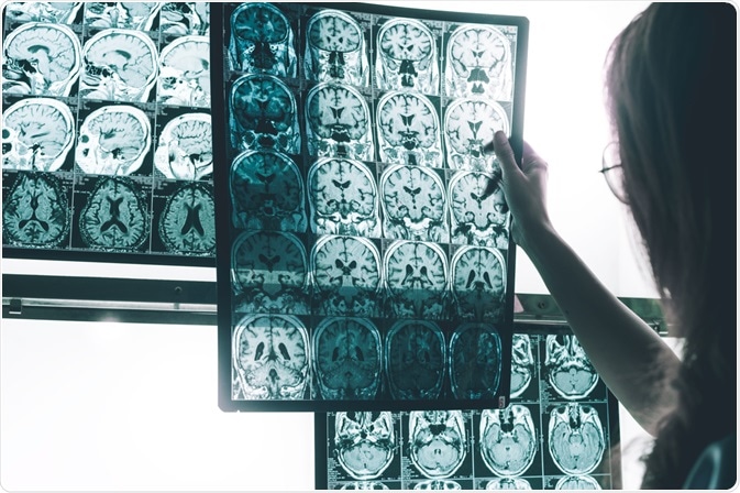Alzheimers Disease Alzheimers Disease