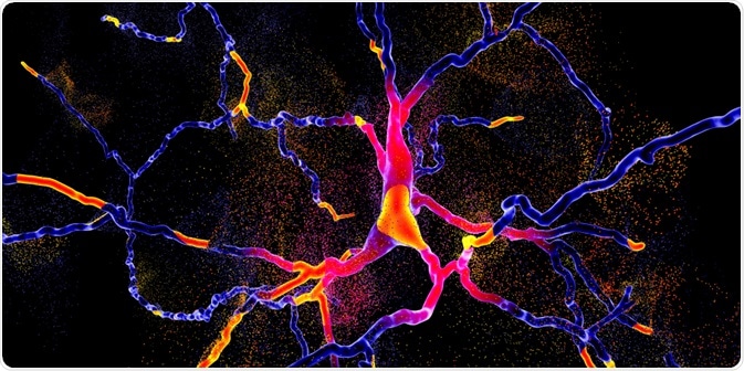Degeneration of dopaminergic neuron Degeneration of dopaminergic neuron