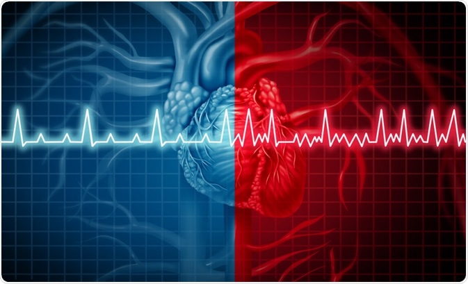 Atrial Fibrillation Atrial Fibrillation