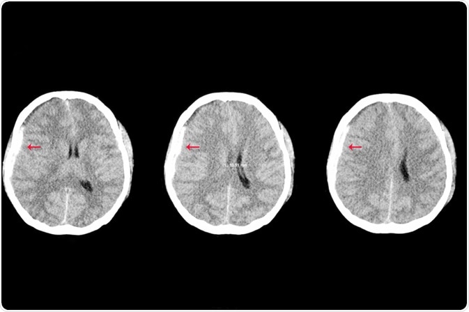 Traumatic Brain Injury Traumatic Brain Injury