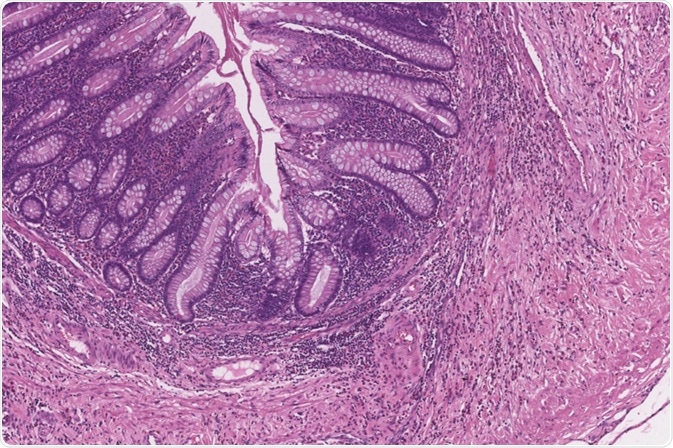 Subtotal Colectomy