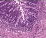 Bowel Preparation for Colectomy: Risks to Watch For