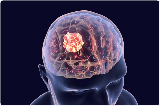 Brain Cancer