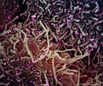 Study focuses on COVID-19 patients with inflammatory rheumatic diseases