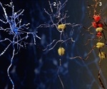 Neurodegeneration: Progressive Neuron Death