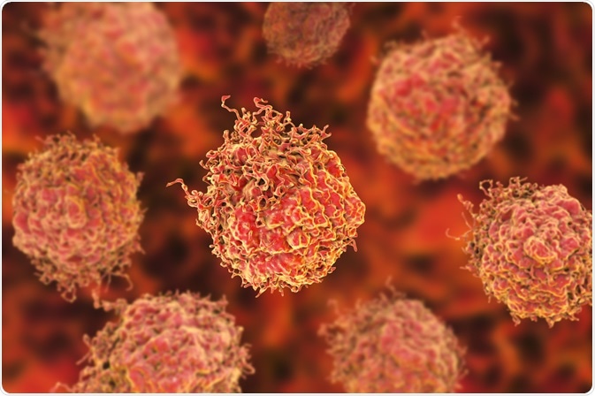 Prostate Cancer