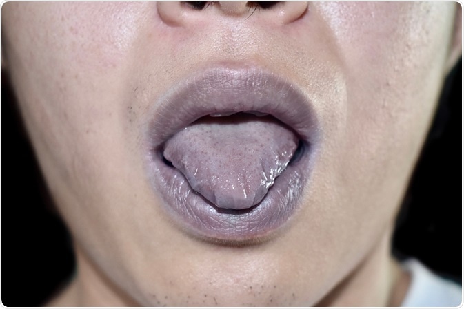 Cyanosis