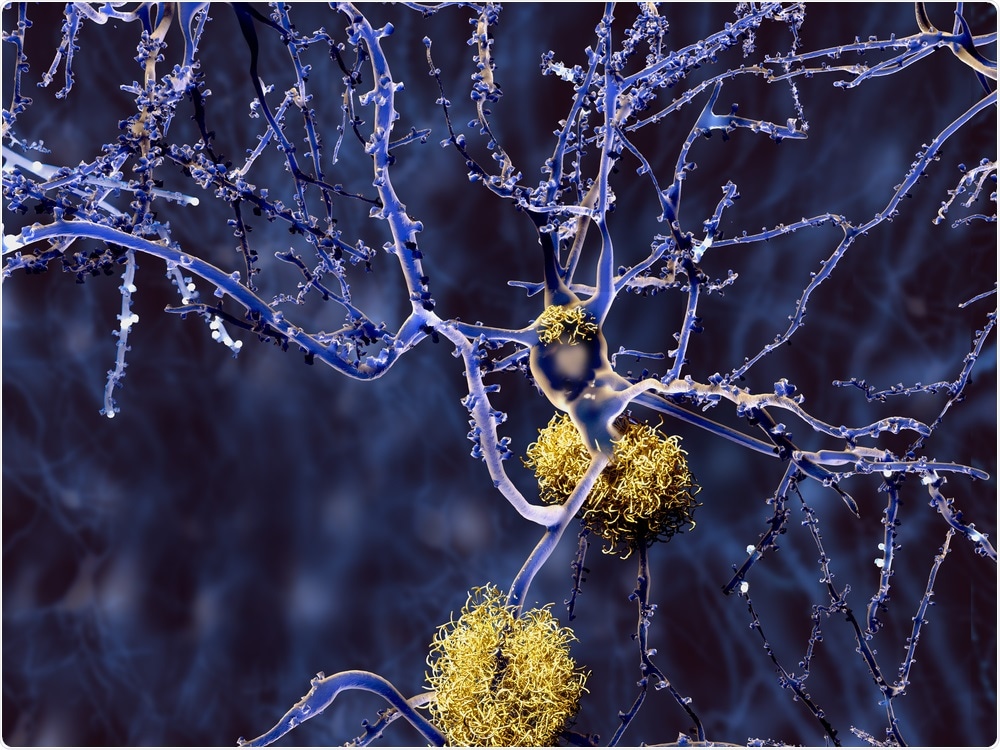Amyloid Plaque