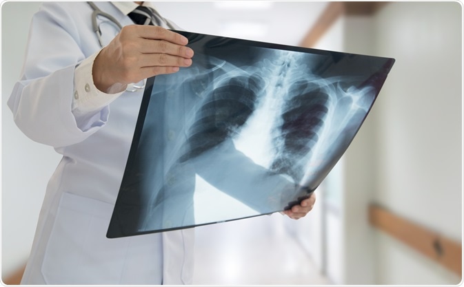Chest X-Ray Chest X-Ray