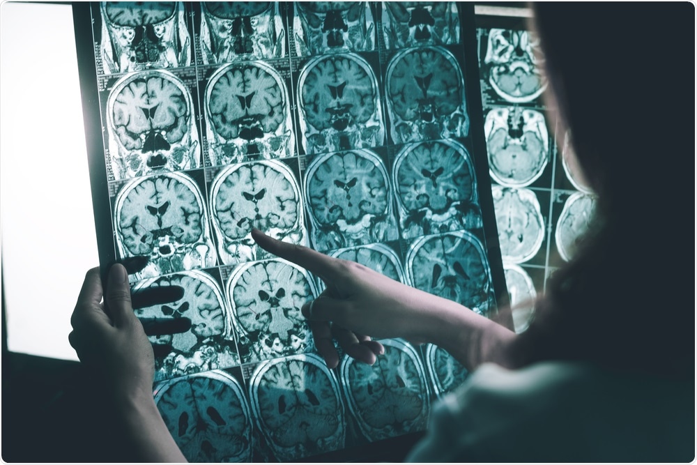 Alzheimers Disease