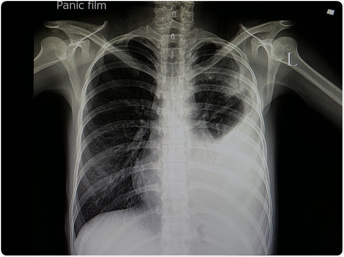 Infectious Pneumonia Infectious Pneumonia