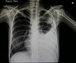 What is Viral Pneumonia?
