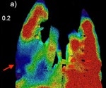 World's first technology aims to help diagnose, treat and manage people with cystic fibrosis