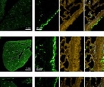 Repurposed drug for acute lung injury in COVID-19