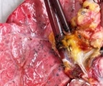 Human lungs rejected for transplant can be recovered using cross-circulation with pigs