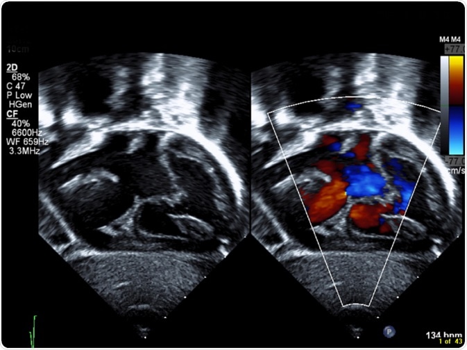 Septal Defect