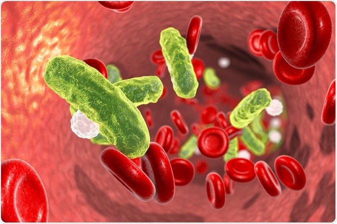 Sepsis Sepsis