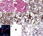 ARDS may not be the primary lung iInjury in COVID-19