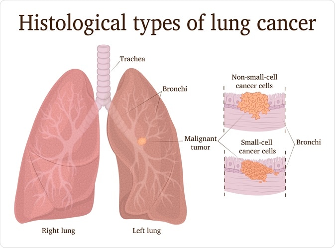 Types of Lung Cancer Types of Lung Cancer