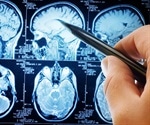 Anxiety and depression coexisting could cause physical changes to the brain