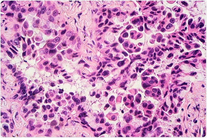 adenocarcinoma adenocarcinoma
