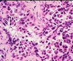 What are the Differences Between Small Cell and Non-Small Cell Lung Cancer?