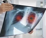 Stages of Lung Cancer