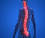 What is Autonomic Dysreflexia?