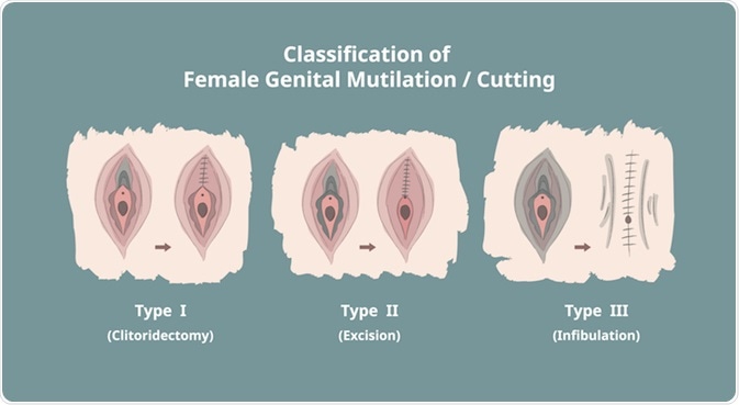 Types of FGM Types of FGM