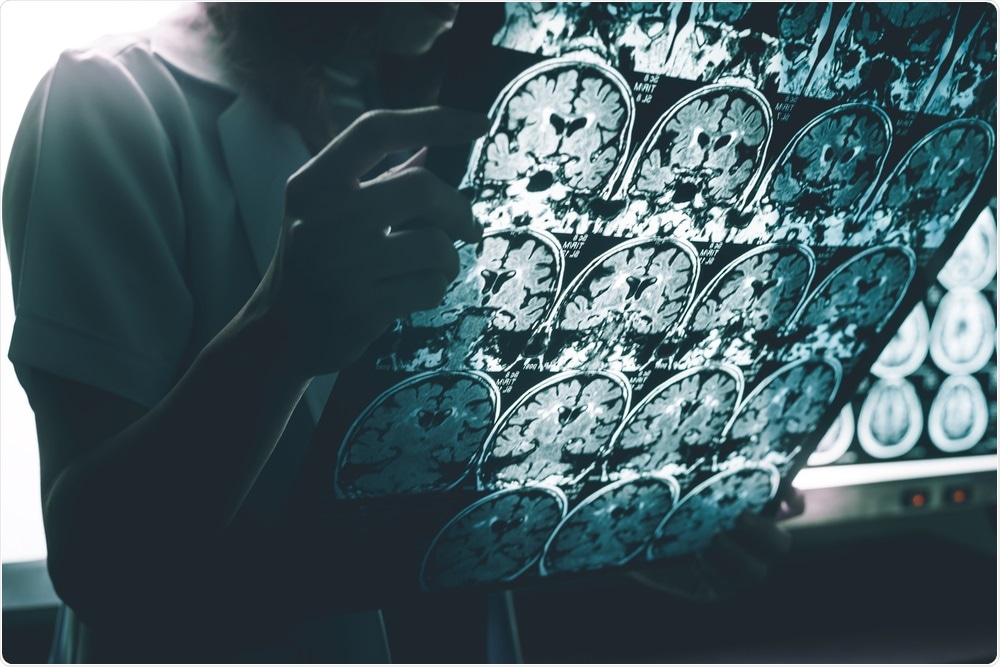 Alzheimers Disease