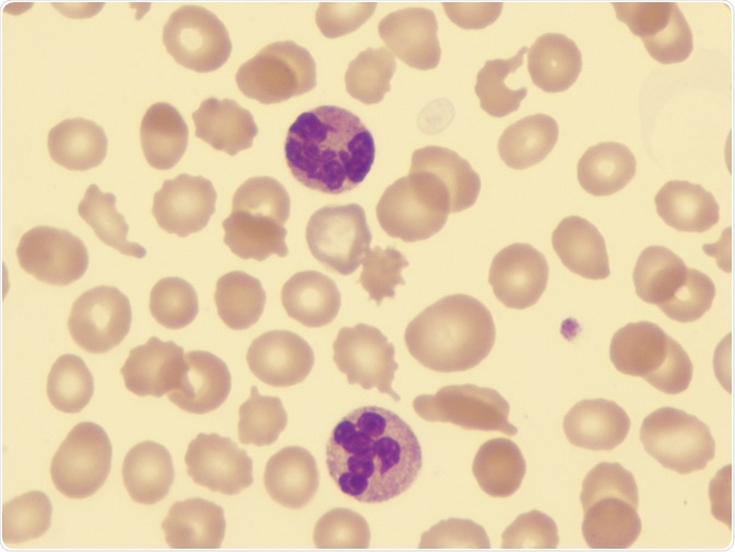 Myelodysplastic syndromes Myelodysplastic syndromes