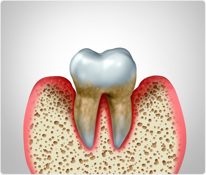 Periodontitis Periodontitis