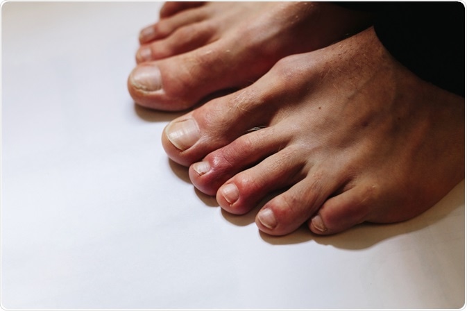 COVID Toes