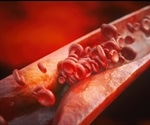 Gender Differences in Coronary Heart Disease