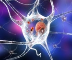 Parkinson's disease diagnosed after SARS-CoV-2
