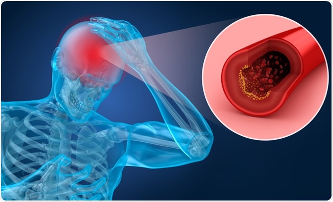 brain ischemia