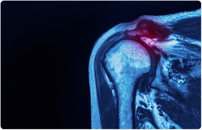rotator cuff