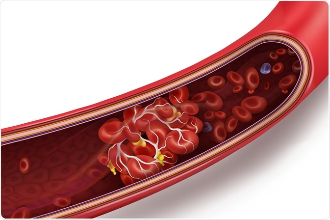 blood clot