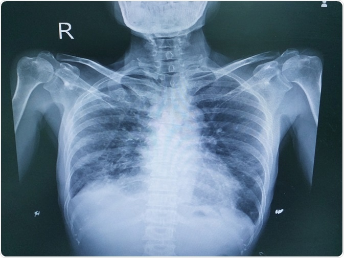 lung disease
